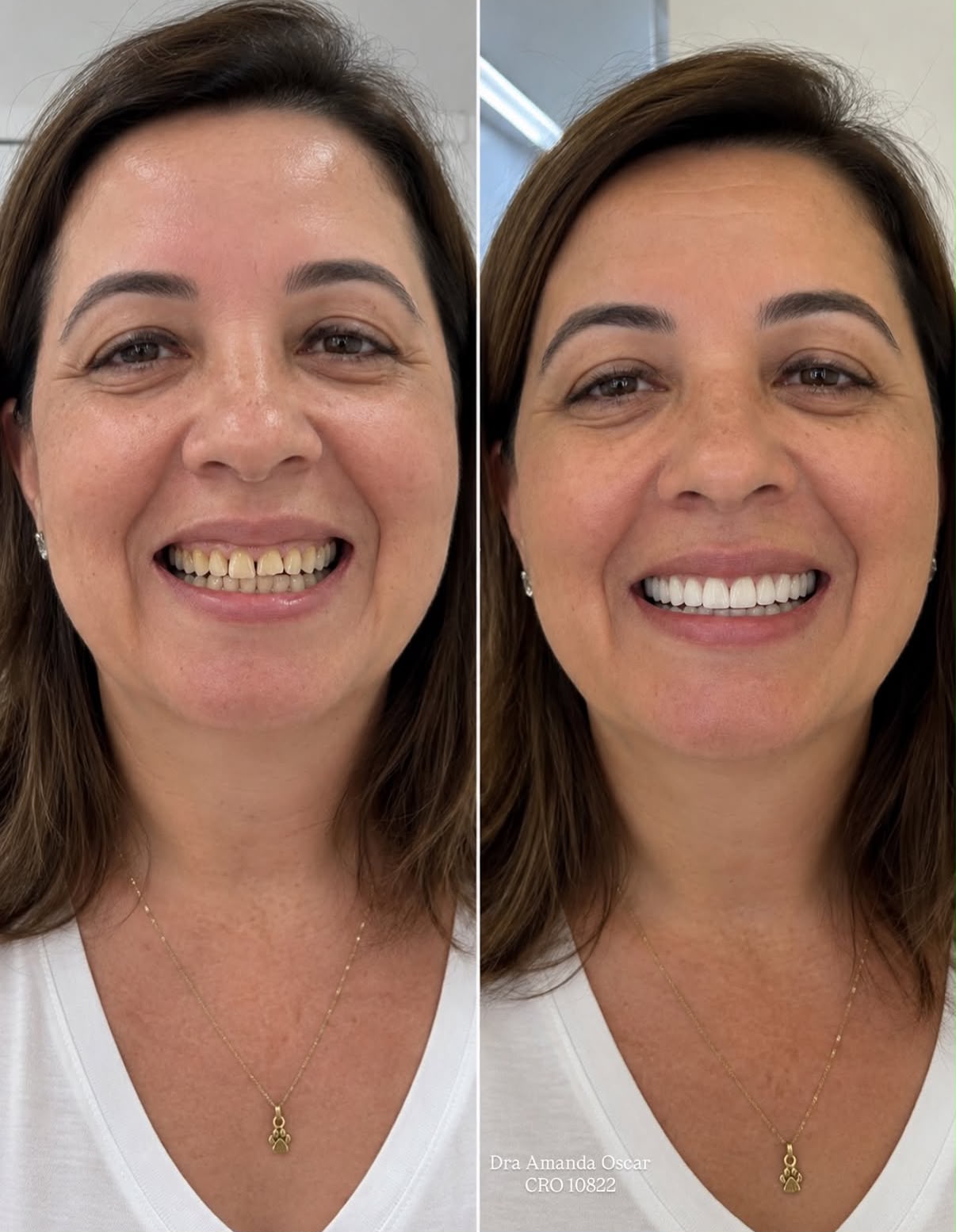 Antes e depois de facetas em resina, caso clínico feminino