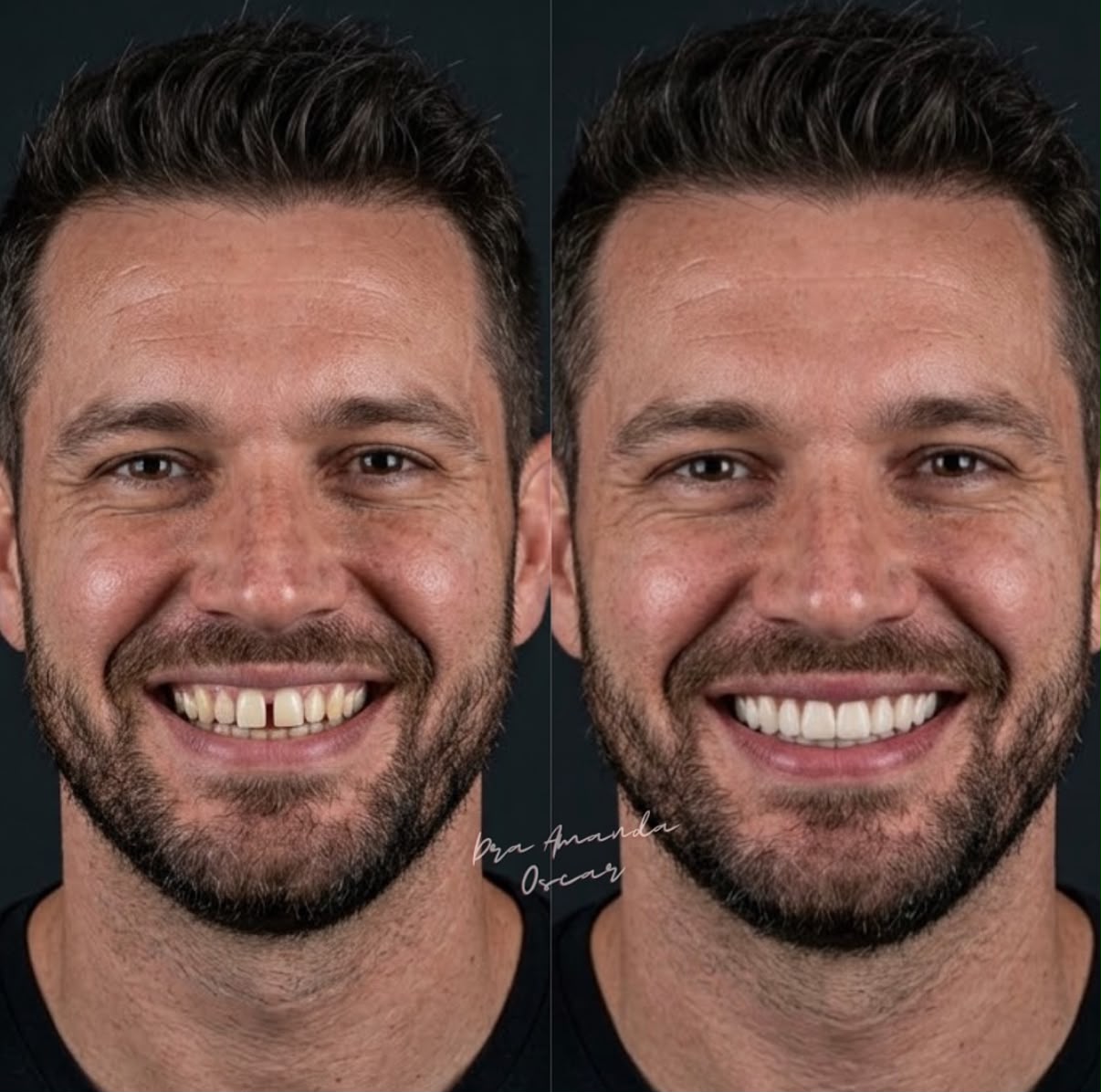 Antes e depois de facetas em resina, caso clínico masculino