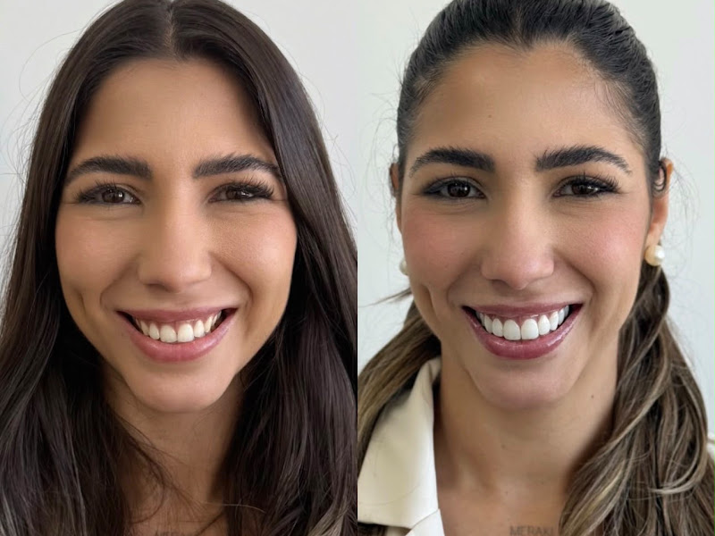 Antes e depois de facetas em resina, caso clínico feminino